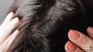 How to Get Rid of Dandruff